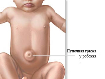 Пупочная грыжа у младенцев: признаки, опасности и лечение